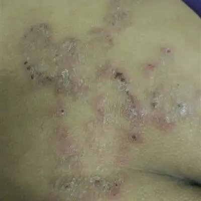 牛皮癣吃什么药好呀