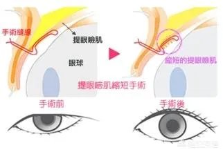 上睑下垂矫正术一定要做双眼皮吗