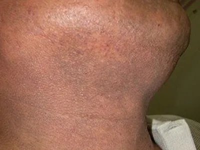 皮肤垢着病症状图片