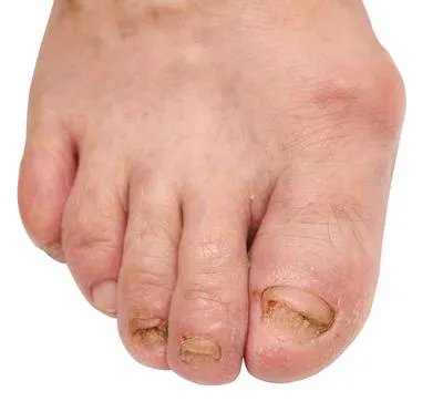 湿性脚气病什么症状表现