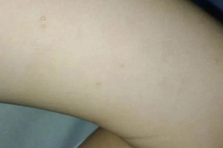 传染性软疣大腿小疙瘩图片