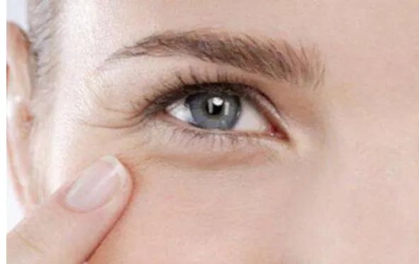 注射botox去鱼尾纹多少钱