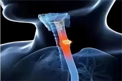 食道癌位置图片大全