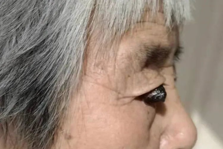 黑色素瘤一般长在什么部位