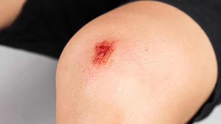 伤口愈合吃什么