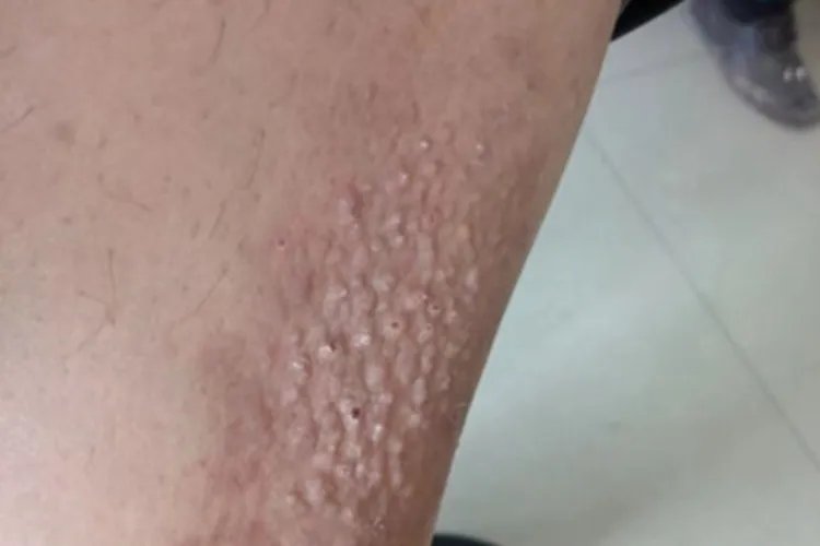 湿疹小疙瘩图片