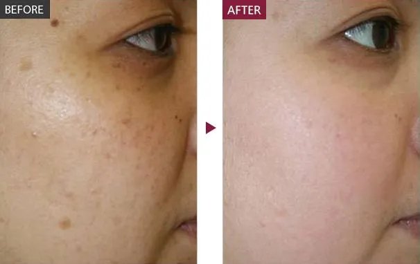 激光美容祛斑多少钱