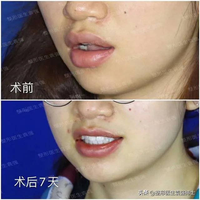 鼻部整形有哪些?