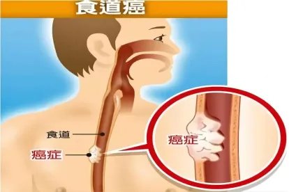 食道癌位置图片大全