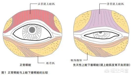 上睑下垂矫正术一定要做双眼皮吗