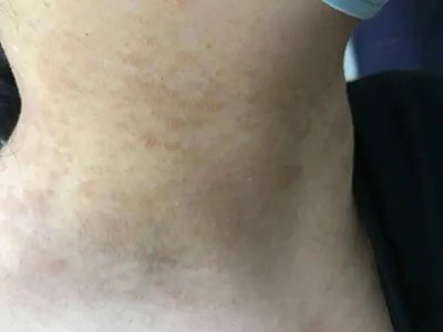 皮肤垢着病症状图片