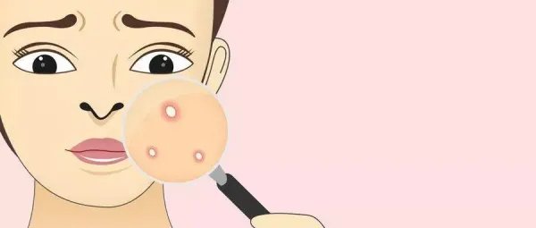 福建一男子反复挤痘出血不止引发血管瘤，有痘痘该如何正确清理？