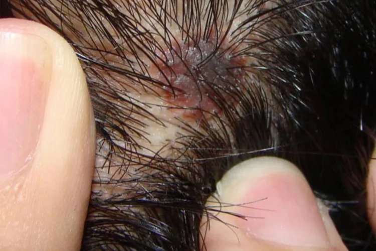 黑色素瘤一般长在什么部位