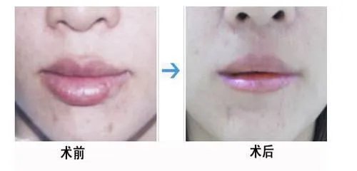 唇部整形对比案例