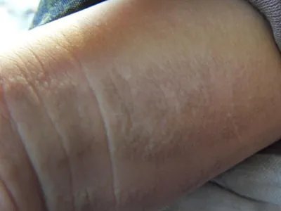 扁平苔藓样接触性皮炎手腕症状图片