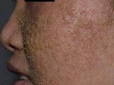 皮肤垢着病症状图片