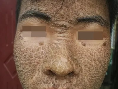 皮肤垢着病症状图片