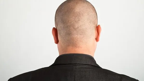 如何治疗脑梗塞