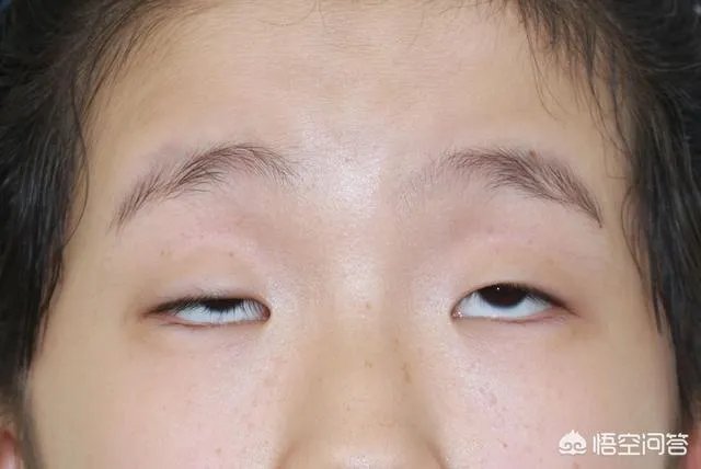 上睑下垂矫正术一定要做双眼皮吗