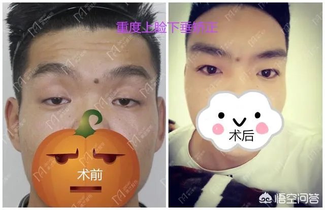 上睑下垂矫正术一定要做双眼皮吗