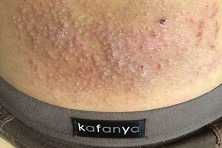 湿疹小疙瘩图片