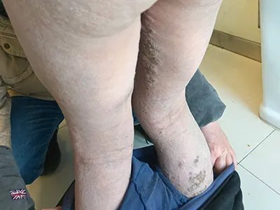 皮肤垢着病症状图片