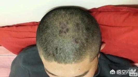 青少年银屑病三大困扰，父母注意到了吗？