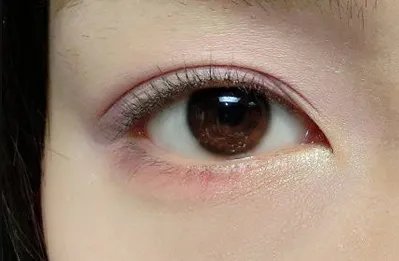 怎样去眼袋安全