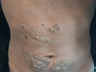 皮肤垢着病症状图片