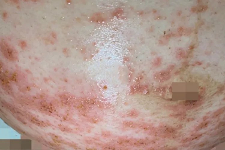 湿疹小疙瘩图片
