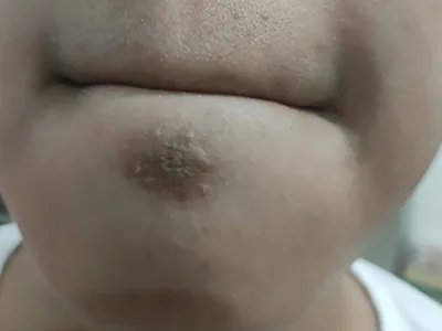 皮肤垢着病症状图片