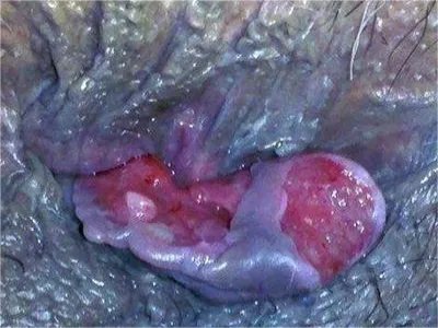 炎性外痔肿块图片