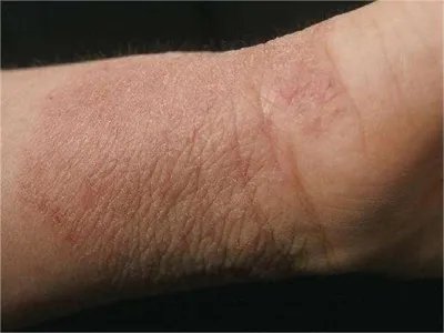 扁平苔藓样接触性皮炎手腕症状图片