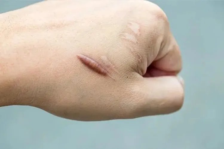 疤痕恢复过程图片