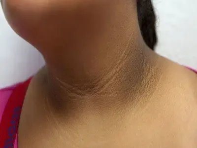 皮肤垢着病症状图片