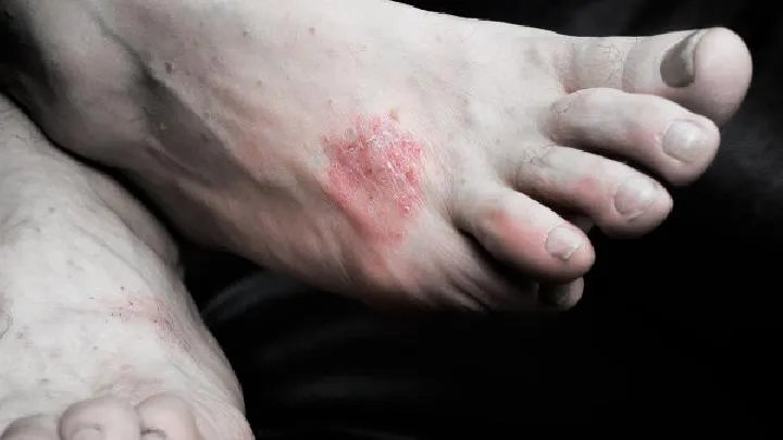 点滴型牛皮癣的症状表现