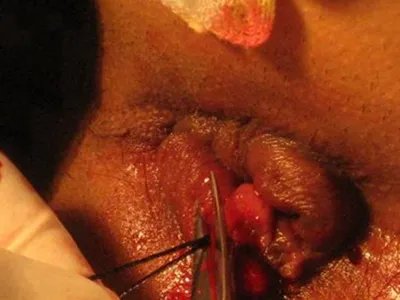 炎性外痔肿块图片