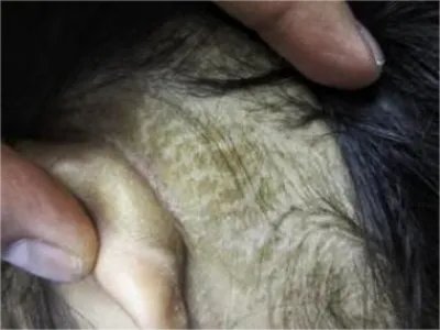 皮肤垢着病症状图片