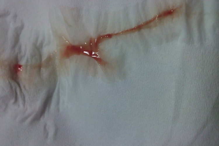 宫颈癌出血跟月经区别图片