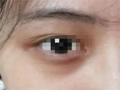 眶周黑变皮肤颜色加深图片