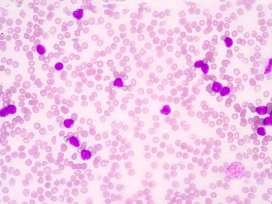 多发性骨髓瘤的症状是什么