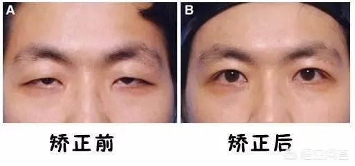 上睑下垂矫正术一定要做双眼皮吗
