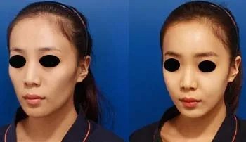 做光子嫩肤需要多少钱