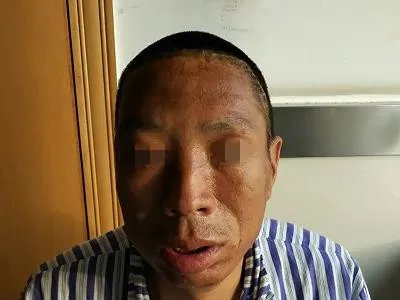 肢端肥大症面部畸形图片