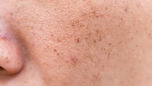 怎样去掉老年斑