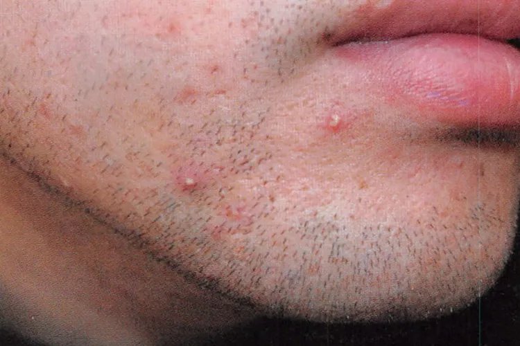 皮肤病真实照片大全