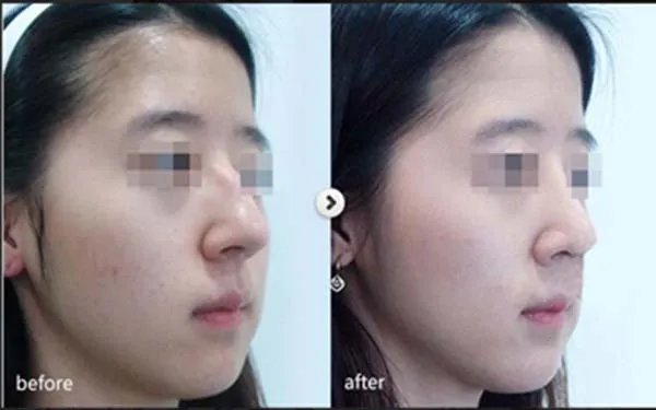 鼻翼缩小安全吗