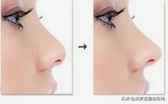 鼻部整形有哪些?