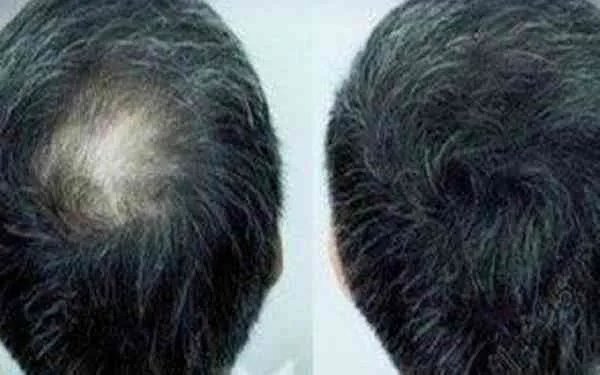 种一根头发多少钱