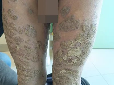 皮肤垢着病症状图片